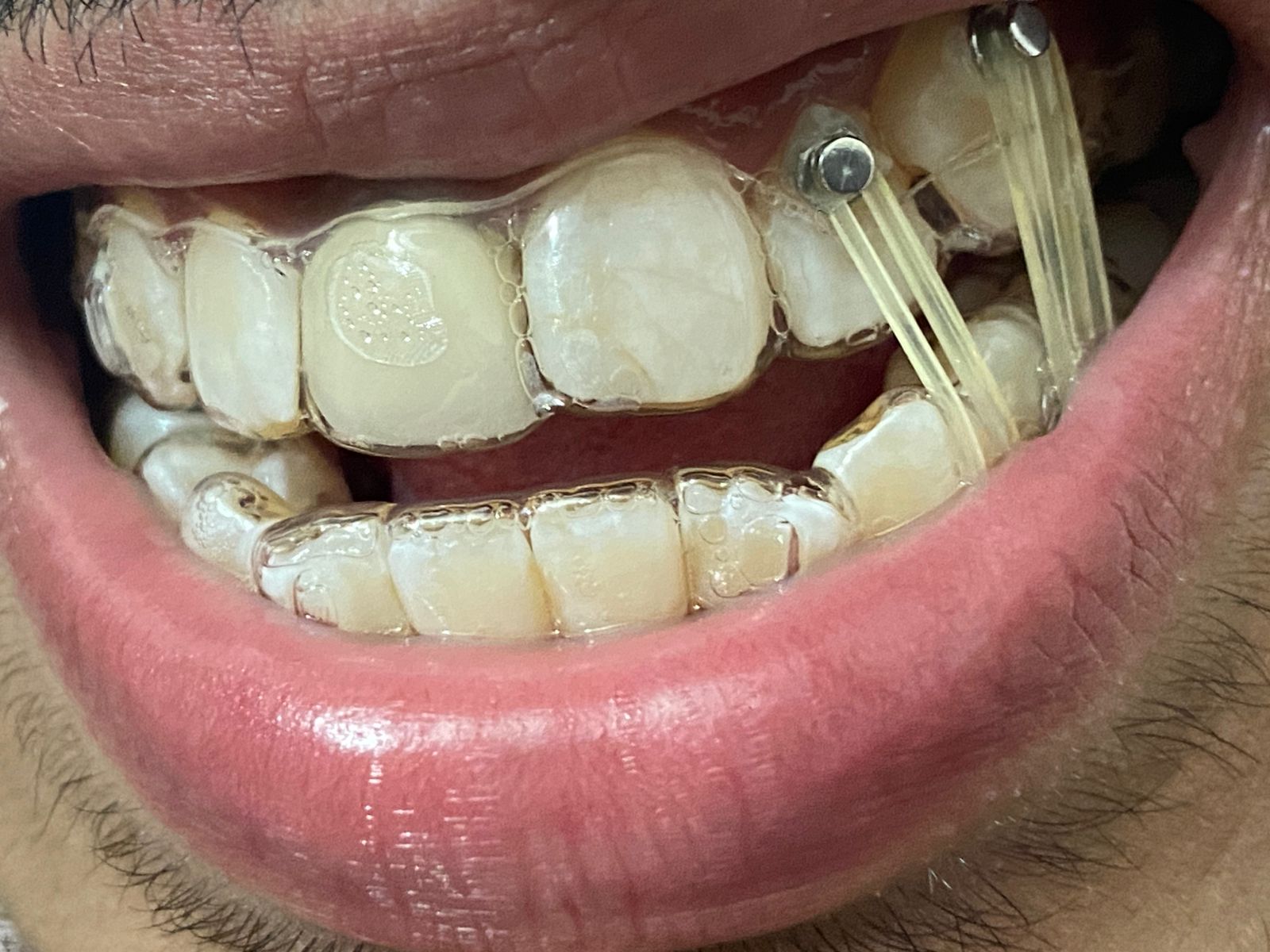 Smile Makeover